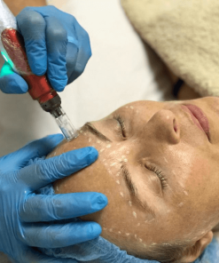 Microagulhamento - Packs de Sessões