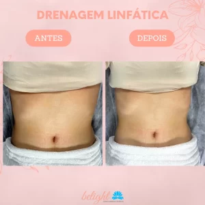 Drenagem Linfática Manual - 1 Sessão