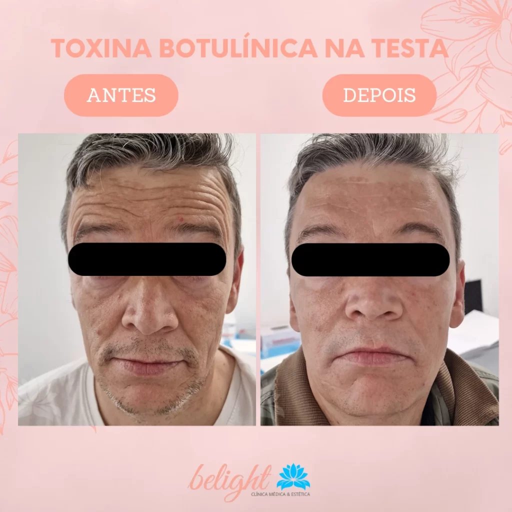 REDUÇÃO DE RUGAS E LINHAS DE EXPRESSÃO