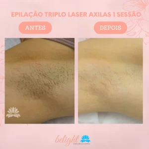 Epilação Triplo Laser