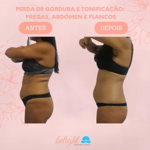 Tratamentos Realizados: Protocolo de Tratamentos Belight, Cavitação, Criolipólise, Drenagem Linfática Manual