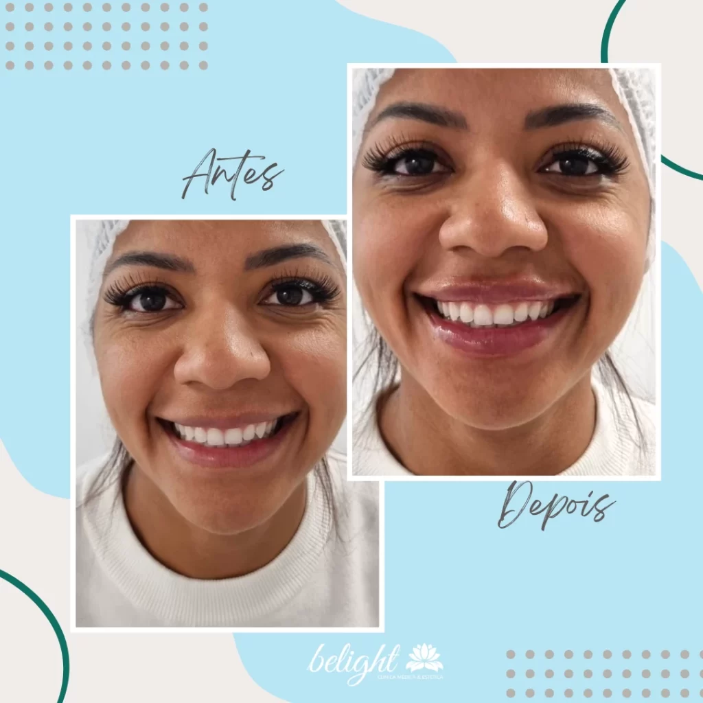 Case de Sucesso - Preenchimento com Ácido Hialurónico (1ml)
