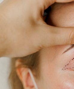 blefaroplastia belight.